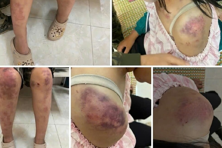 Bé gái bị gia đình bên nội tra tấn vì nghi trộm tiền