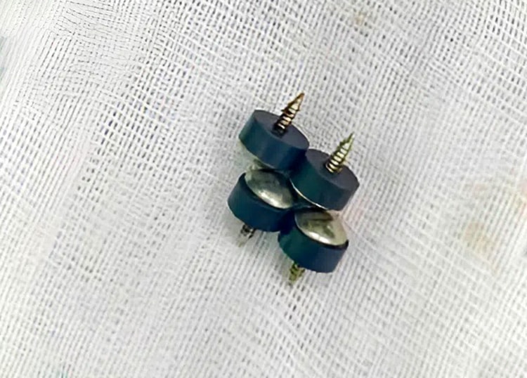 Bé 2 tuổi nuốt 4 đinh nam châm