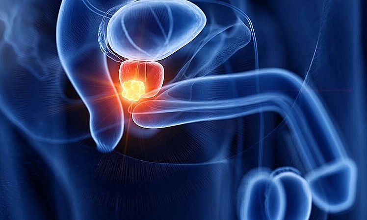 Ai dễ mắc ung thư tiền liệt tuyến?