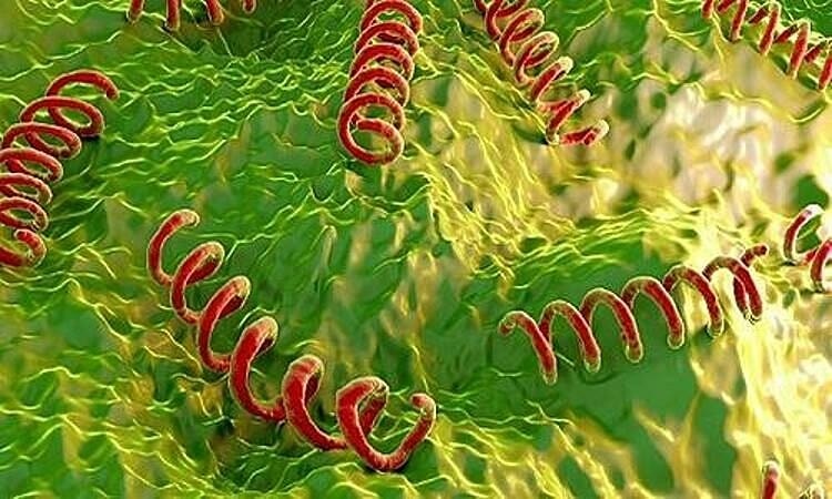 Người đàn ông 65 tuổi mắc giang mai thần kinh