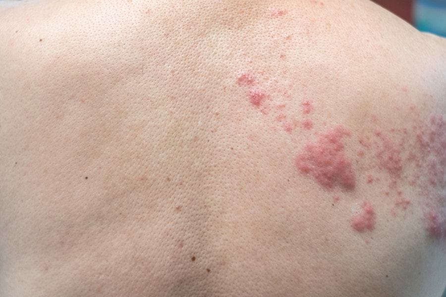 Zona thần kinh tái phát sau 5 năm