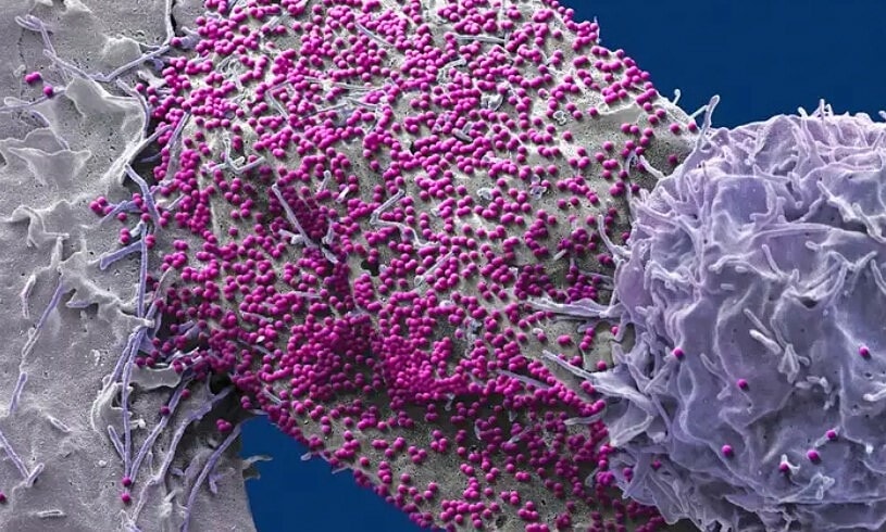 Bất ngờ khỏi HIV sau khi ghép tế bào gốc