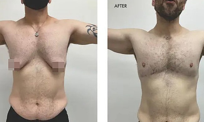 Đàn ông Mỹ chi hàng chục nghìn USD 'dao kéo' thu nhỏ ngực