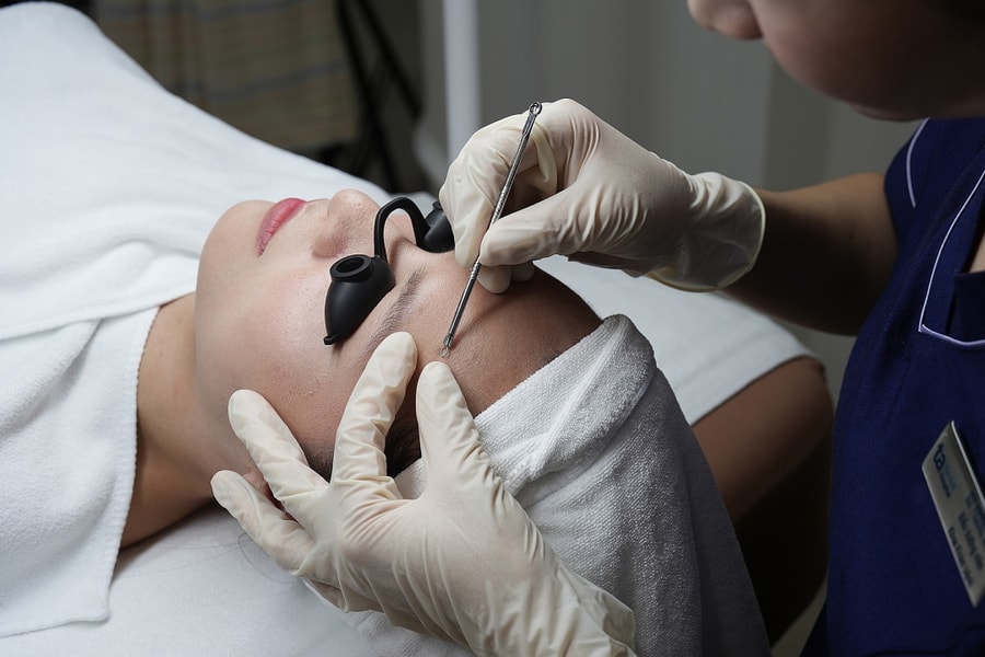 Nổi nhiều mụn sau peel da có đáng lo không?