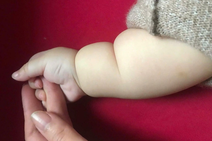 Tay chân trẻ có ngấn do bụ bẫm hay bất thường?