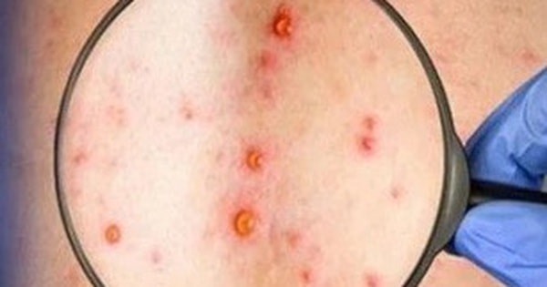 Đồng Nai ghi nhận ca mắc đậu mùa khỉ chưa rõ nguồn lây