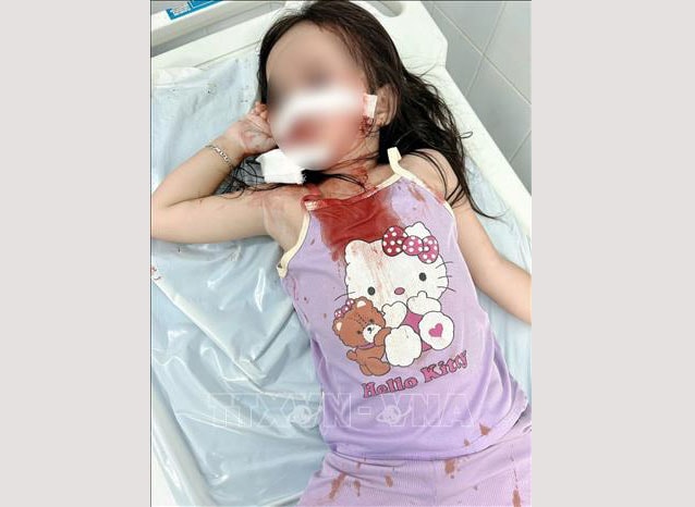 Bé gái 4 tuổi bị chó thả rông tấn công, thương tích nghiêm trọng vùng mặt