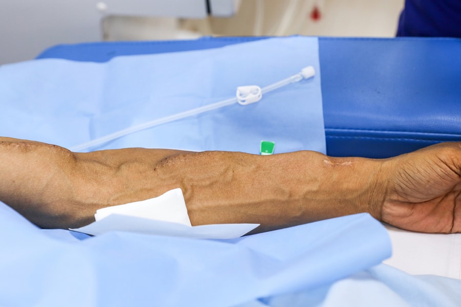 Chi phí chạy thận một tháng hết nửa thu nhập gia đình