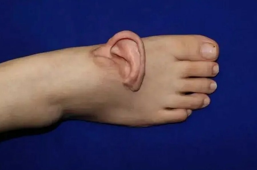 Tai đứt lìa được cấy lại sau 5 tháng 'nuôi' trên chân