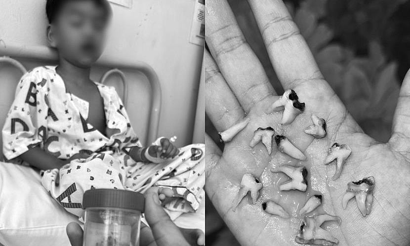 Nhổ 12 răng sâu cùng lúc vì thói quen ngậm bình sữa khi ngủ