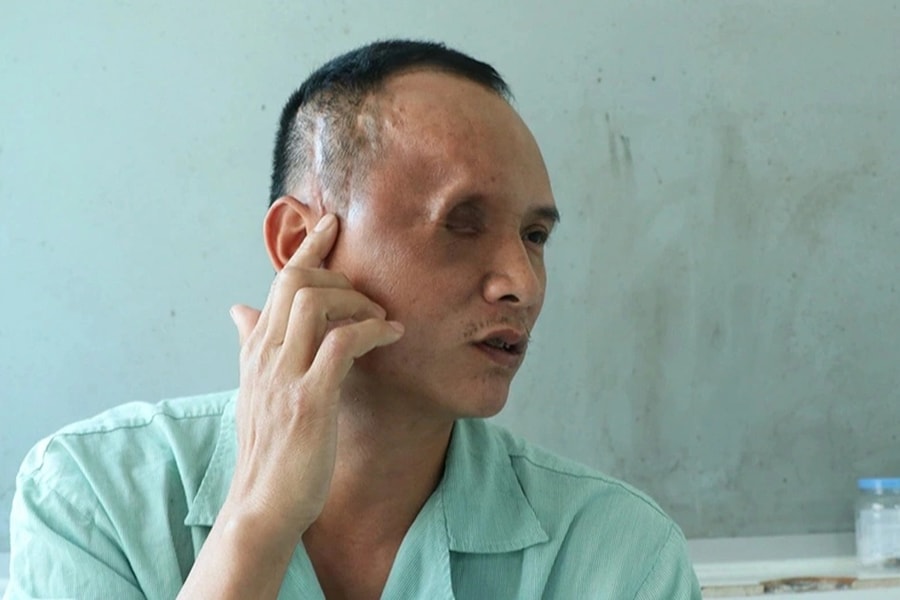 Người đàn ông mắc ung thư hiếm phải khoét một mắt, gồng gánh nuôi 3 con nhỏ