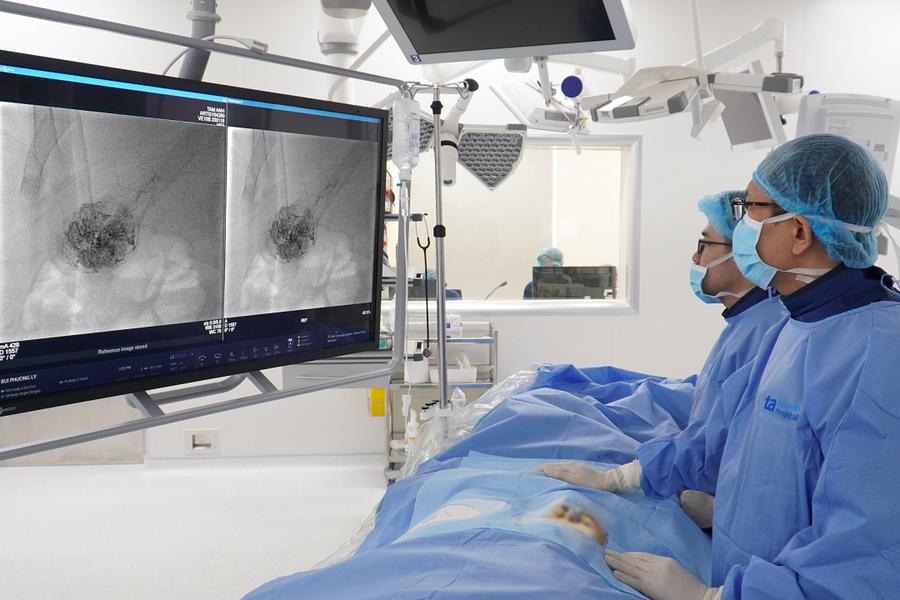 Nút mạch triệt căn hai u gan ác tính