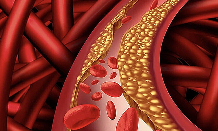 Vì sao ăn uống, tập thể dục điều độ nhưng mỡ máu vẫn cao?