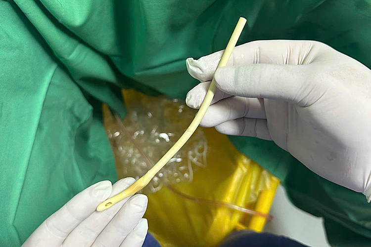 Cụ ông tự cắt đứt ống thông tiểu khiến dây tụt vào bàng quang