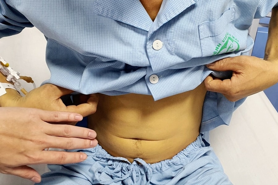 Suýt chết vì nuốt mật cá trắm để 'tăng cường sinh lực'