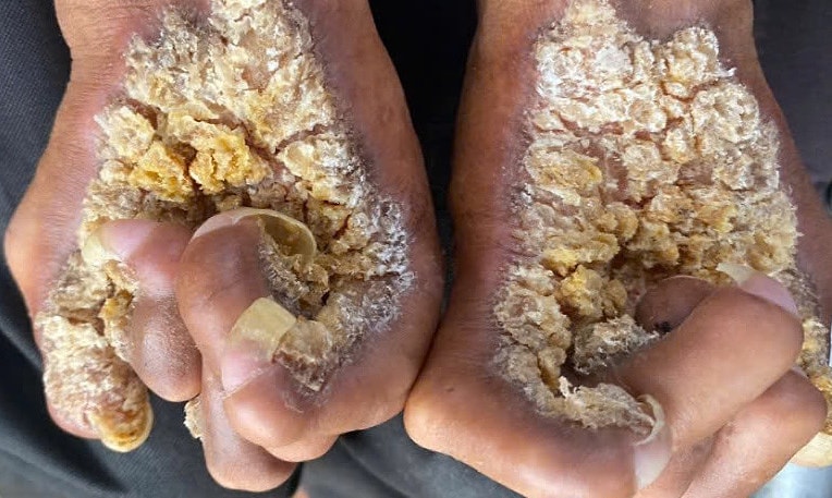 Người đàn ông mắc hội chứng 'người cây'