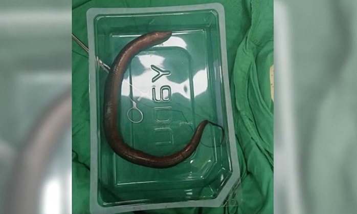 Lươn dài 30 cm bơi trong ổ bụng chàng trai