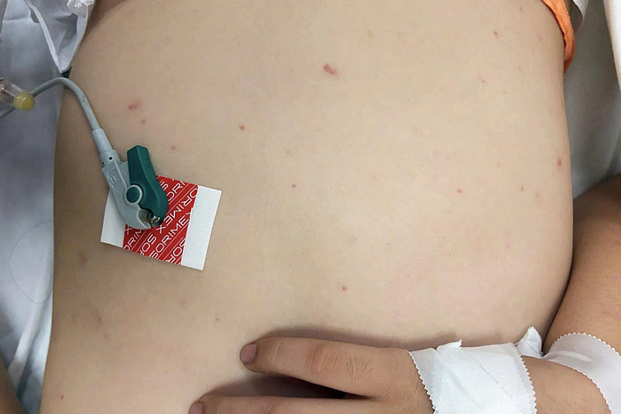 Dấu hiệu mắc não mô cầu - căn bệnh có thể tử vong trong 24 giờ