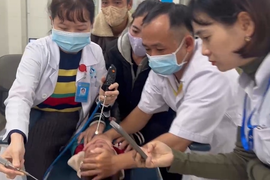 Gắp con vắt ký sinh một tuần trong mũi bé trai 2,5 tuổi