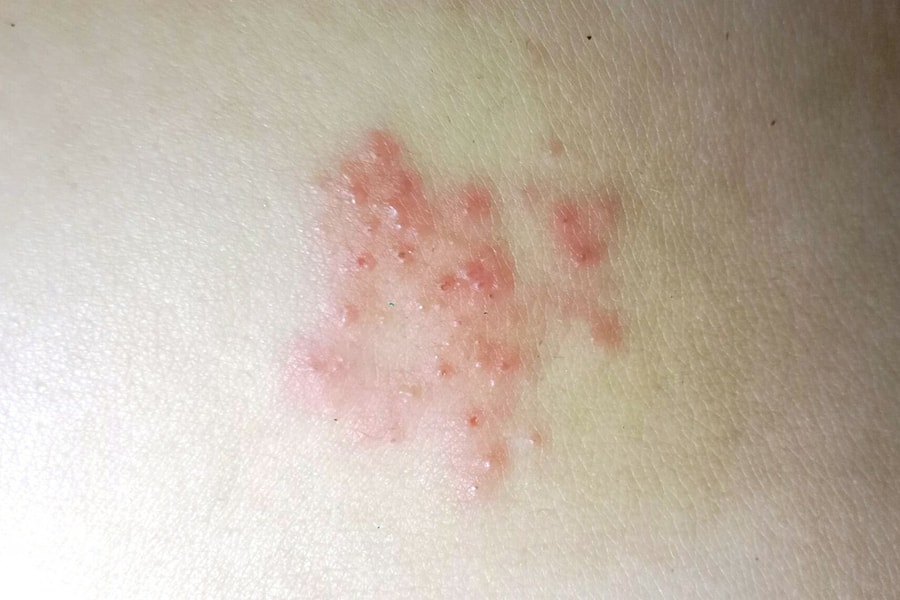 Hiểu nhầm zona thần kinh không tái phát