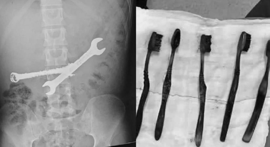 Bác sĩ lấy 2 cờ lê sắt và 7 bàn chải từ bụng nam thanh niên