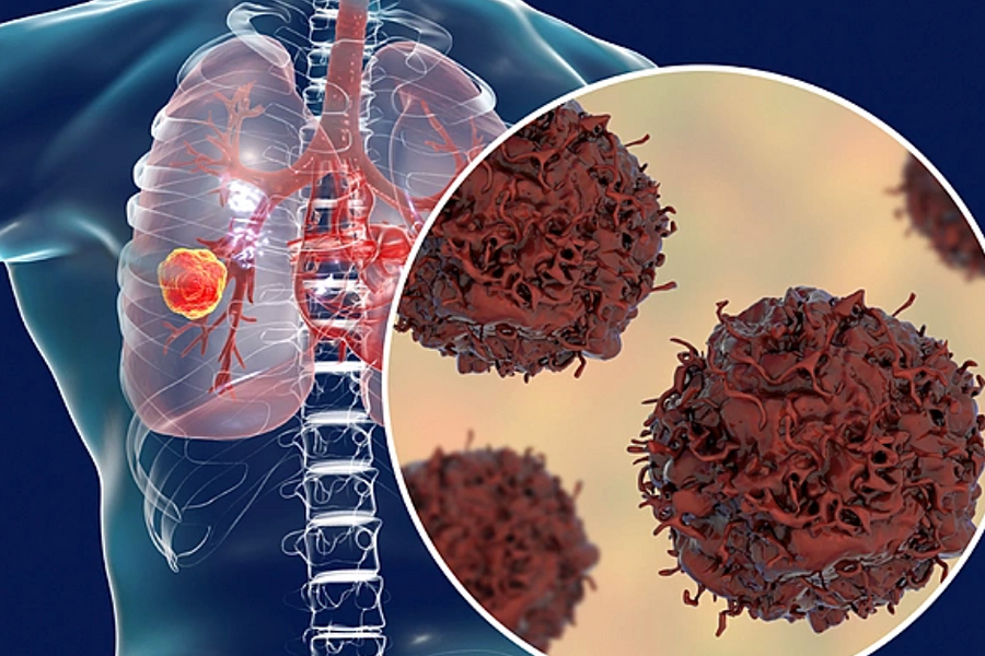 Tự sờ thấy hạch cổ, đi khám phát hiện ung thư phổi di căn