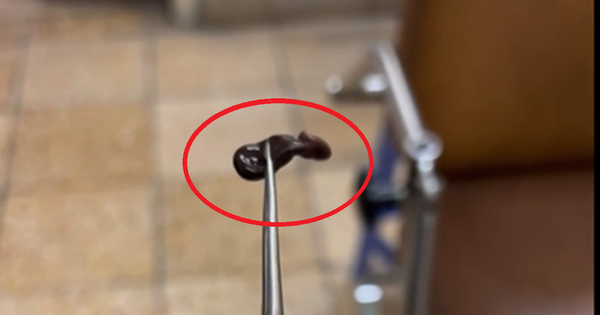 Bé trai 4 tuổi rỉ máu mũi kéo dài, bác sĩ gắp ra thứ "đáng sợ" bên trong