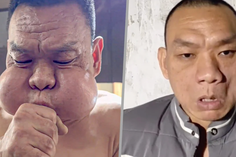 Dung mạo biến dạng của thợ thổi thủy tinh 30 năm