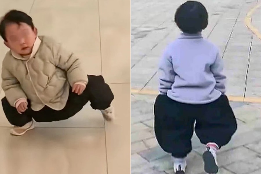 Mẹ chữa khỏi dị tật khớp háng cho con nhờ bài tập 'dáng đi vịt'