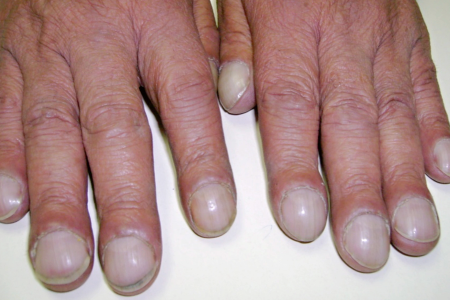 Móng tay tiết lộ gì về sức khỏe?