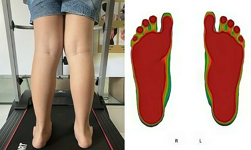 Bàn chân bẹt ảnh hưởng đến sự phát triển của trẻ như thế nào?