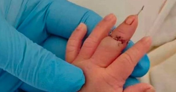 Nữ hộ sinh làm đứt ngón tay bé trai khi cắt dây rốn