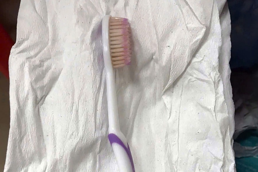 Gắp bàn chải đánh răng trong thực quản nữ bệnh nhân