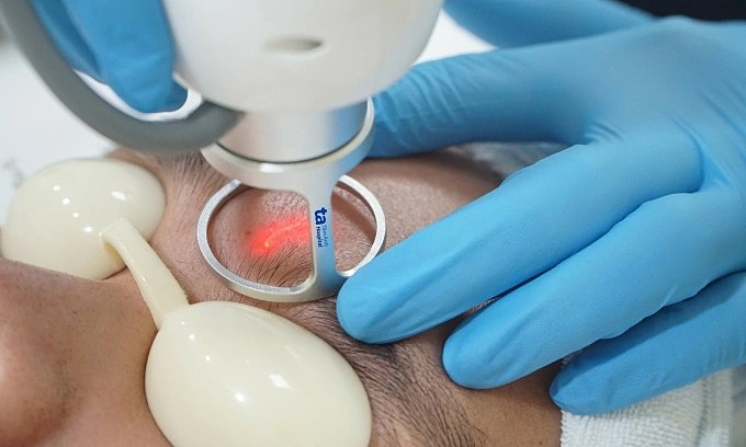 Bị sẹo rỗ vì trị thủy đậu sai cách