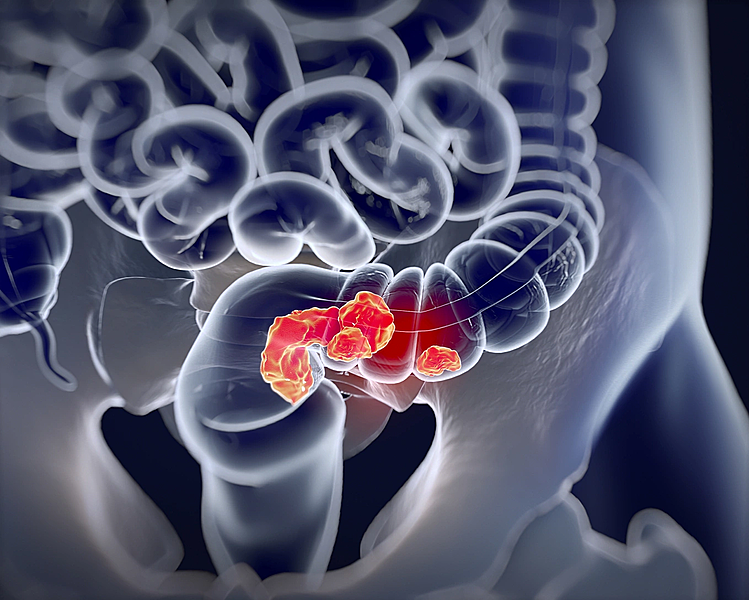 Mắc hai loại ung thư đường tiêu hóa