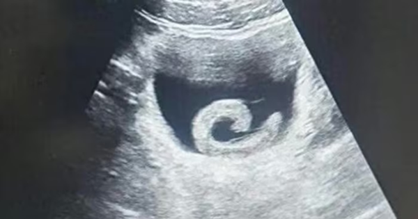 Đi siêu âm, người đàn ông sốc nặng khi thấy con vật "bơi" trong bụng mình