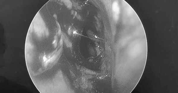 Đi khám, người đàn ông sốc nặng khi bác sĩ thấy thứ "đáng sợ" trong mũi mình