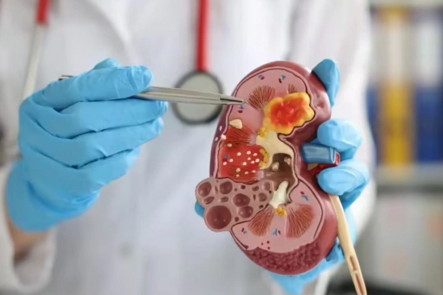 Bác sĩ cảnh báo thói quen phổ biến âm thầm gây hại thận
