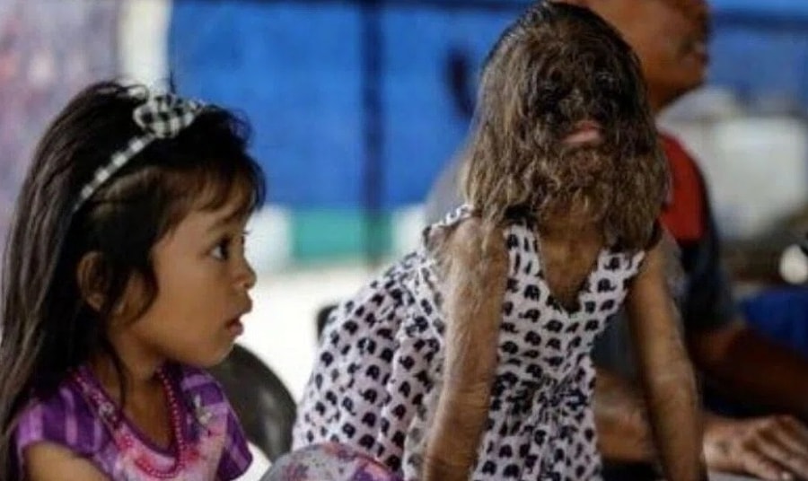 Chương mới cuộc đời cô bé 'người sói'