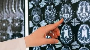 Bé trai 13 tuổi xuất huyết não sau 20 phút ngâm bồn nước nóng