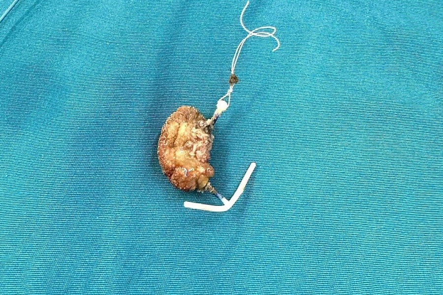 Vòng tránh thai di lệch vào bàng quang sau 22 năm