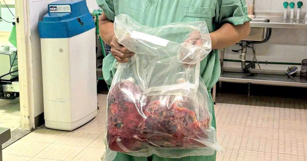 Lần đầu tiên tại Việt Nam: Cắt bỏ hai thận đa nang nặng gần 10kg, ghép thận thành công trong một ca mổ