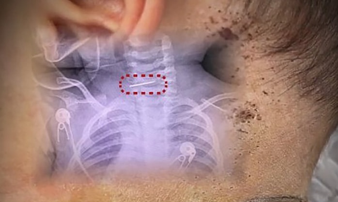 Bé 10 tháng tuổi bị mẹ đâm hàng trăm vết kim vào người để chữa bệnh