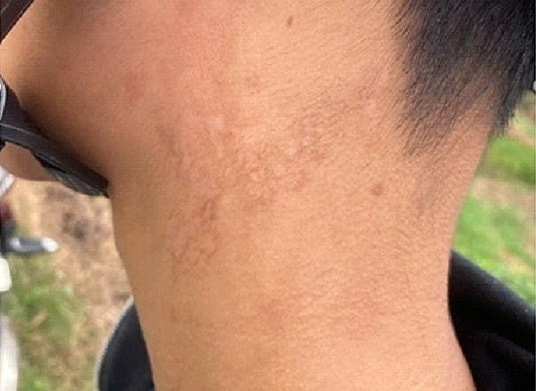 Sẩn ngứa suốt năm, đi khám phát hiện nhiễm sán dây chó