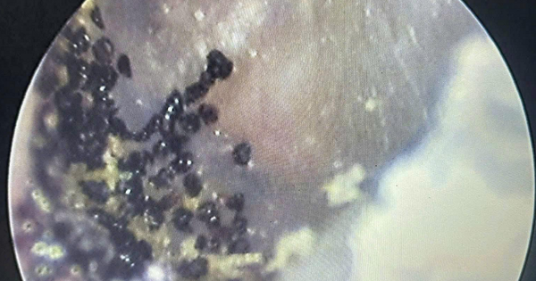 Nghe thấy âm thanh lạ trong tai, bé 7 tuổi đi khám thì sốc nặng