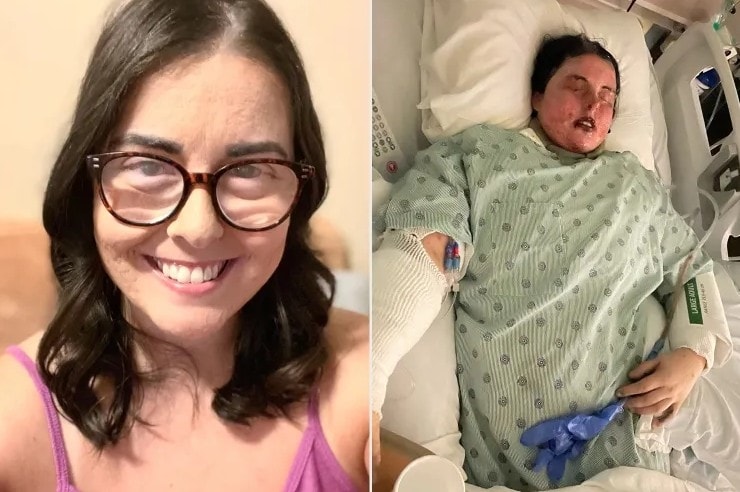 Mẹ đơn thân mù lòa, hoại tử da do phản ứng thuốc