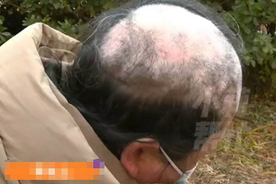 Bị chồng bỏ vì mắc bệnh lạ gây hói đầu