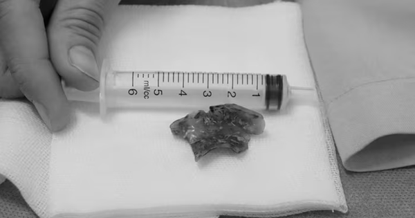 Nửa đêm đau họng, người phụ nữ 55 tuổi phát hiện bí mật "đáng sợ"