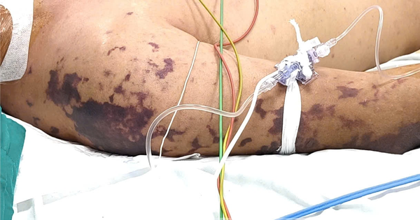 Ăn thịt lợn ở đám cỗ, người đàn ông 52 tuổi lơ mơ, nguy kịch