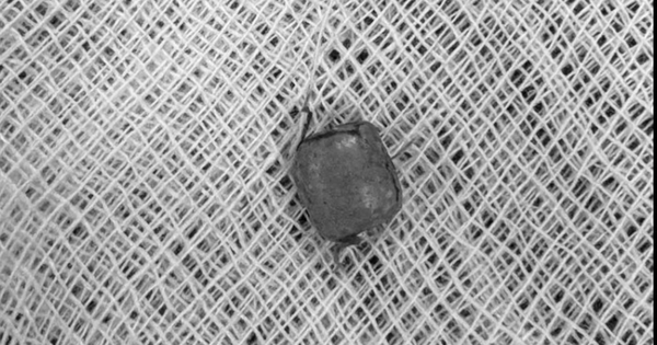 Bé 10 tuổi ù tai kéo dài, bác sĩ lấy ra thứ "đáng sợ" bên trong